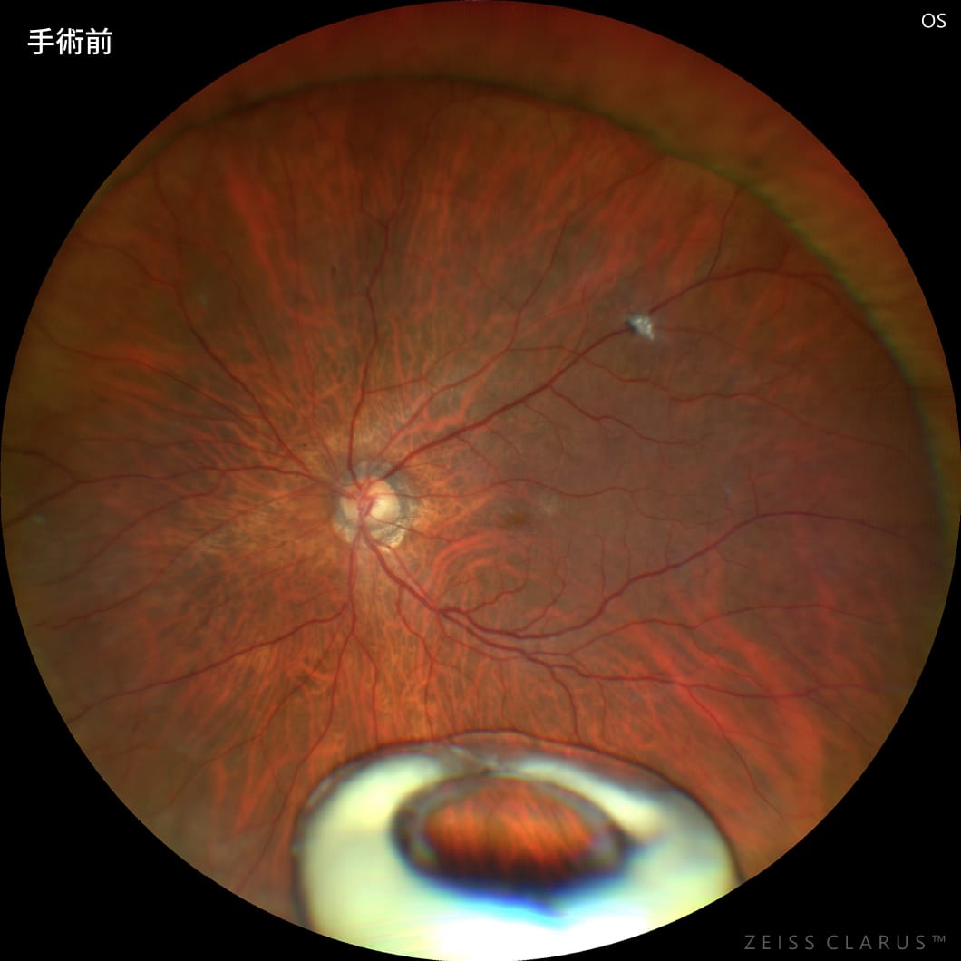 眼内レンズ脱臼1　手術前