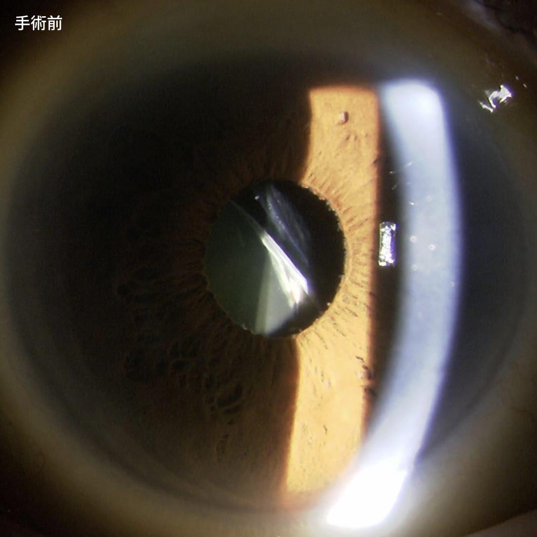 眼内レンズ脱臼2　手術前
